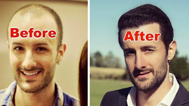 Natural hair Replacement Natural hair Replacement